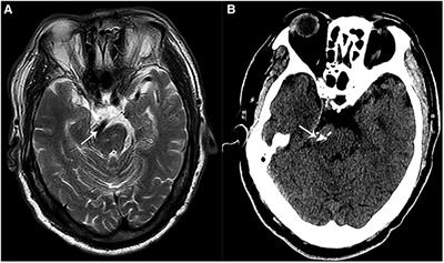 Postoperative hemorrhage after biomedical glue sling technique in microvascular decompression for vertebrobasilar artery-associated cranial nerve diseases: A retrospective study of 14 cases